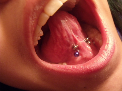Tongue Frenulum Piercing Gone Wrong