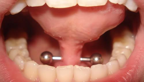Dare To Have A Lingual Frenulum Piercing?