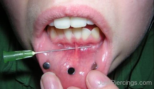 Dermals Lip And Frowney Piercing With Cannula
