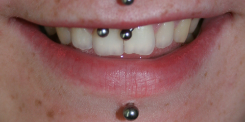Smiley And Labret Piercings