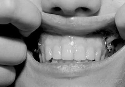 Gum Piercing For Young Girls-JP12305