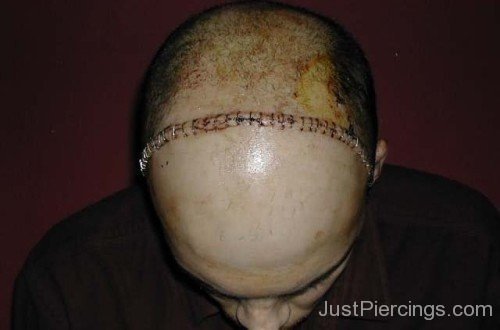 Staple Piercings On Men Forehead-JP12319