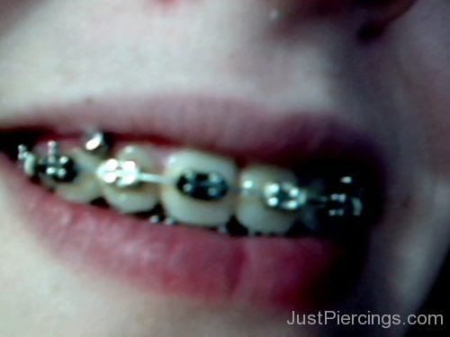 Gum Piercing Image-JP107