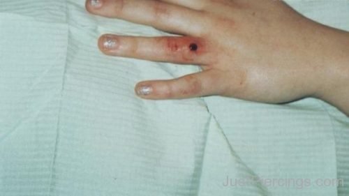 Infected Microdermal Finger Piercing-JP1183